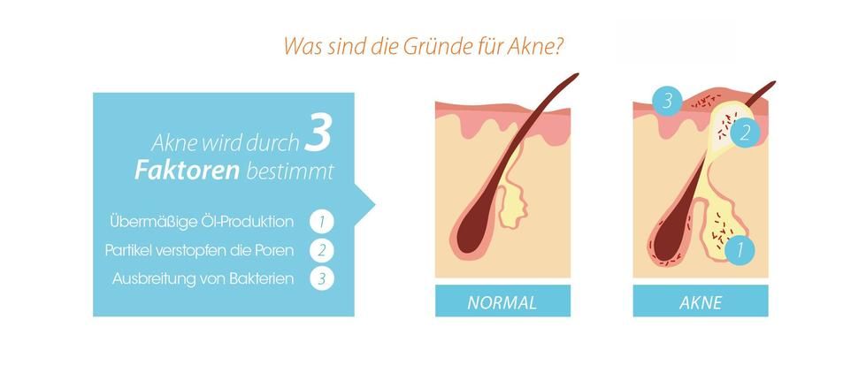 Akne - Informationenblatt