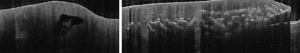 Optische Kohärenztomografie