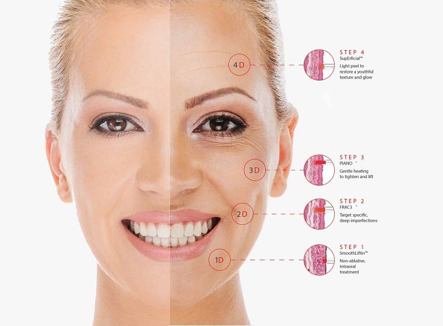 4D Laserlifting - Info