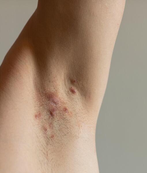 Akne inversa  Hidradenitis suppurativa